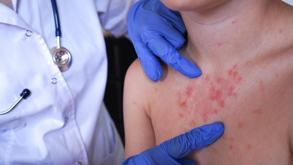 Minnesota's 80 measles cases this year are the most since 1990, health officials say — White Bear Lake Health news